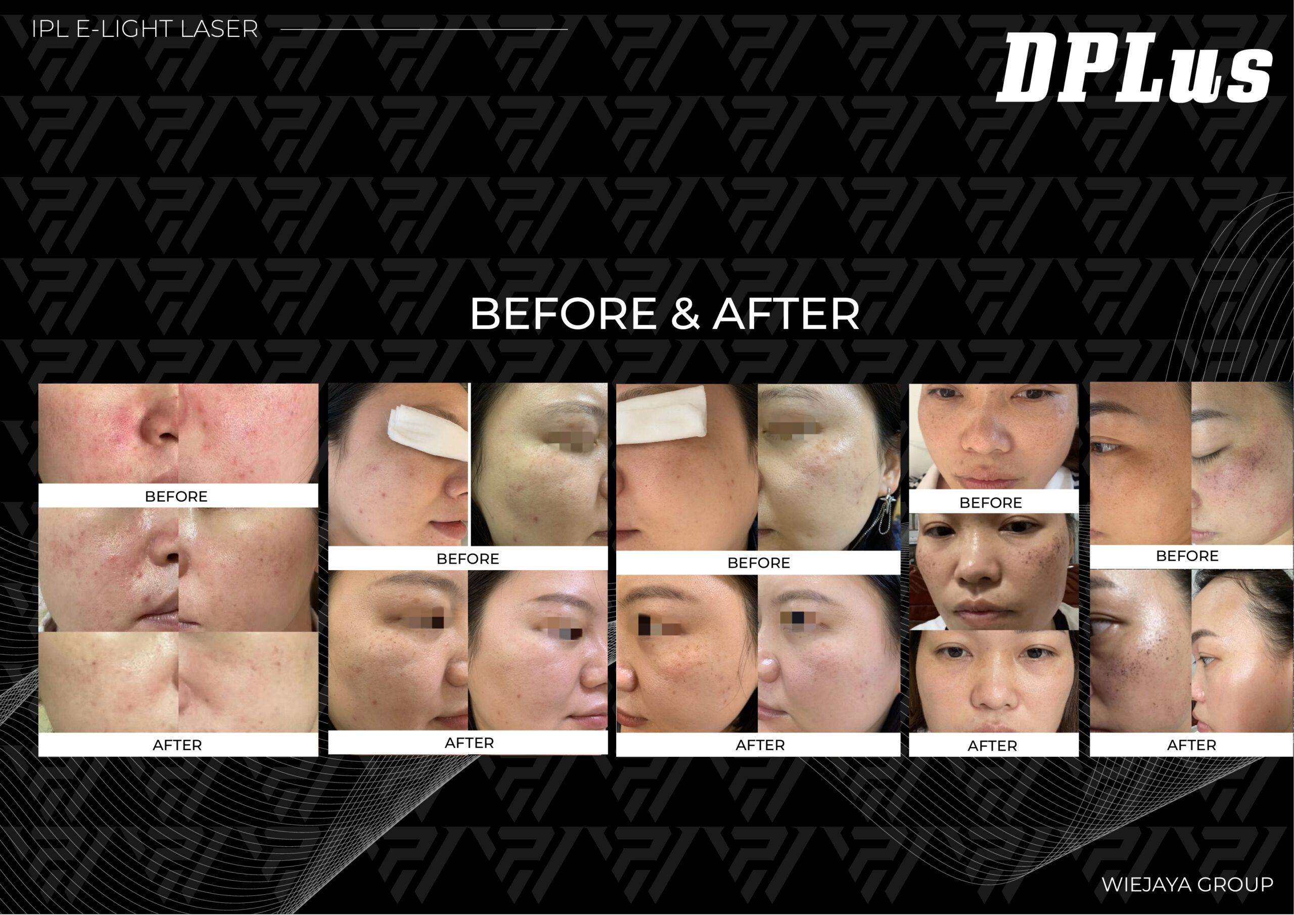 Alat DPLUS ini selain untuk treatment hair removal juga bisa untuk skin rejuve, acne rejuve, pigmentasi, dan vascular.