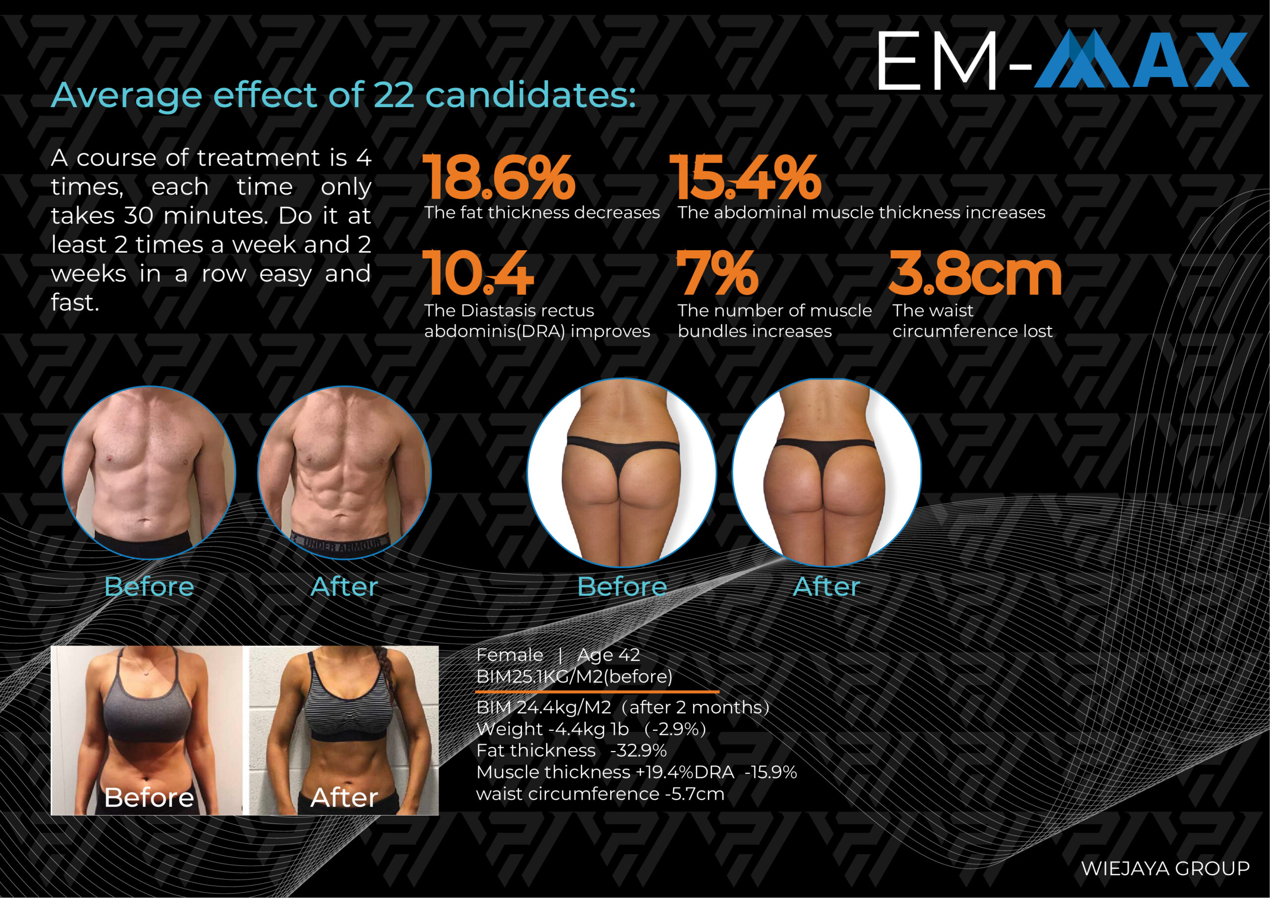 EM-MAX adalah alat HIFEM ( High Intensity Focused Electrical Muscular ) yang kuat namun tidak invasif untuk mengkontraksikan otot di area yang ditargetkan