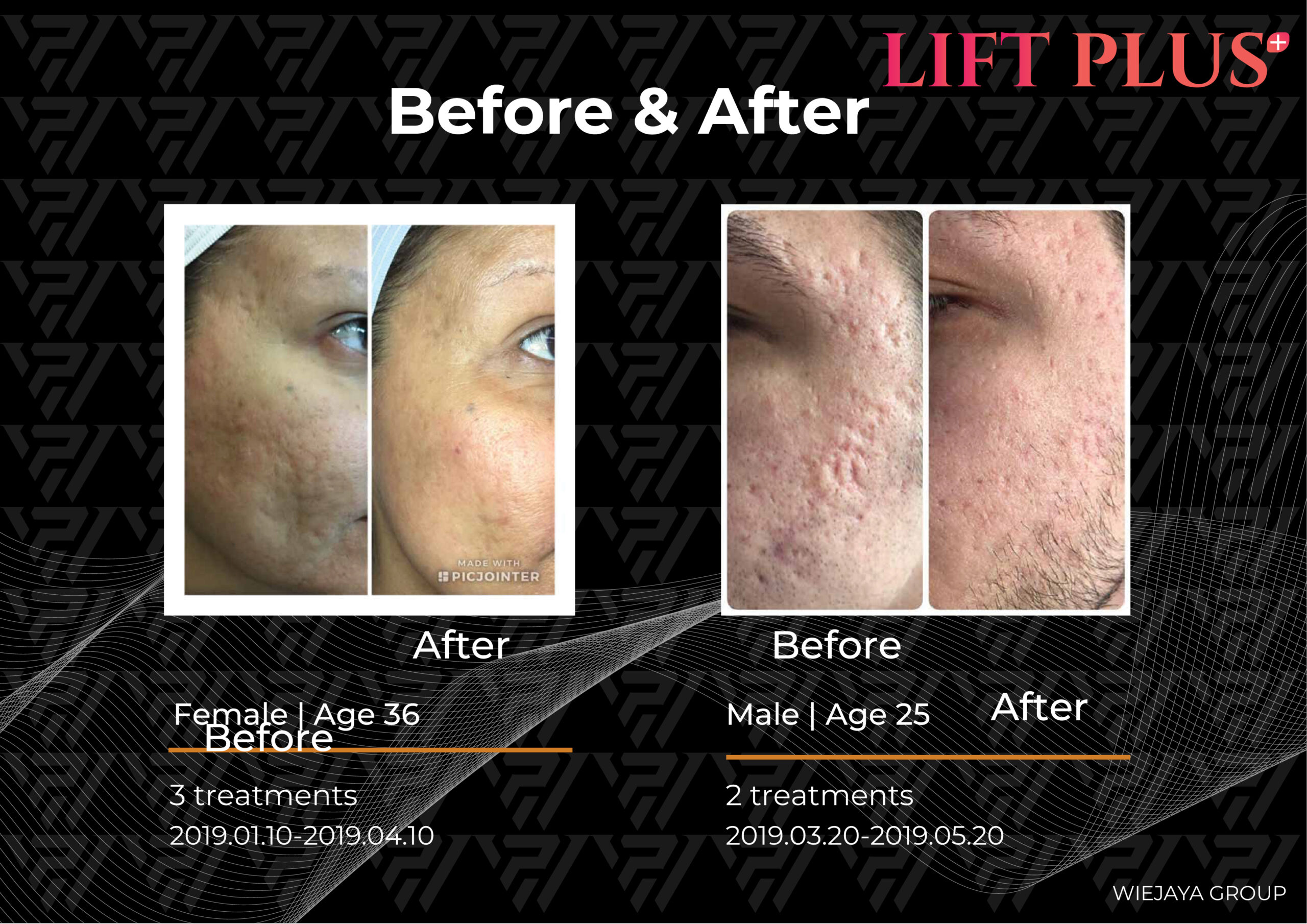 Lift Plus dapat mengatasi keluhan Bopeng, stretch mark, Uneven Skin Tone, Kerutan pada wajah, bekas jerawat, pori pori besar, dan dapat memudarkan pigmentasi sekaligus mengencangkan kulit.