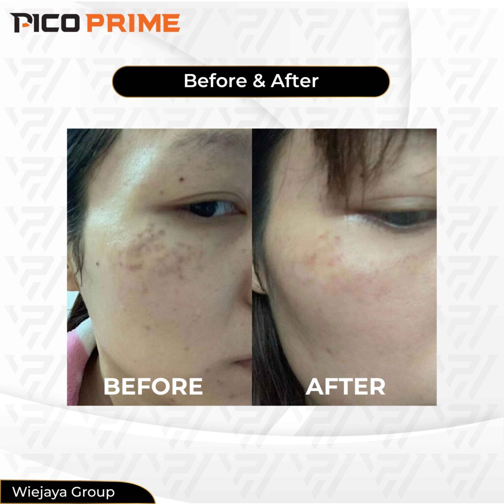 pico laser before and after