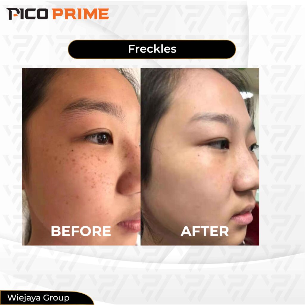 pico laser treatment, pico laser before and after