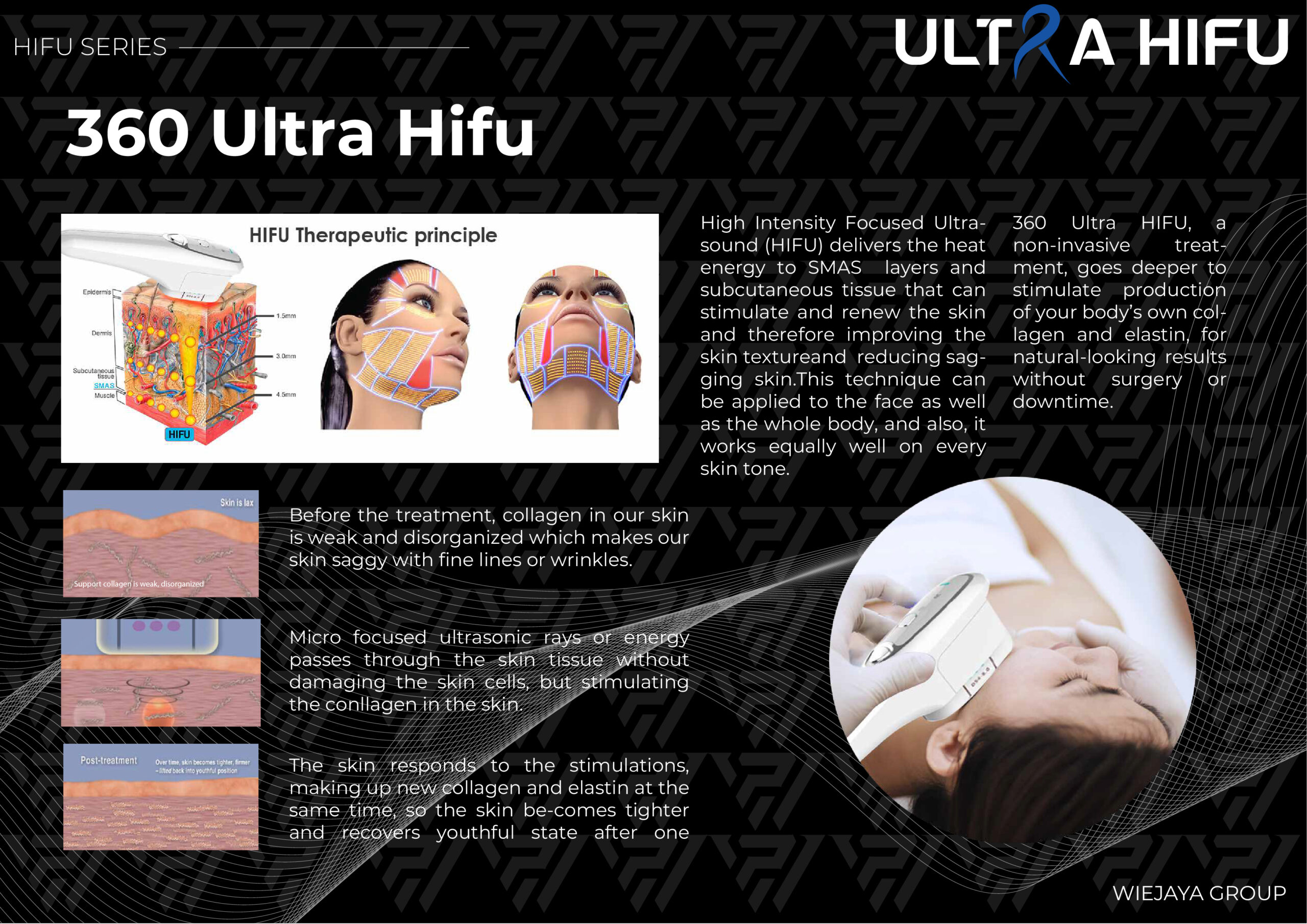 Ultra HIFU Adalah High-intensity Focused Ultrasound (HIFU) dengan teknologi non-invasif yang Ideal untuk menghilangkan kulit kendur